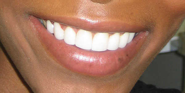 Case 3 — Whitening & Reshaping — after